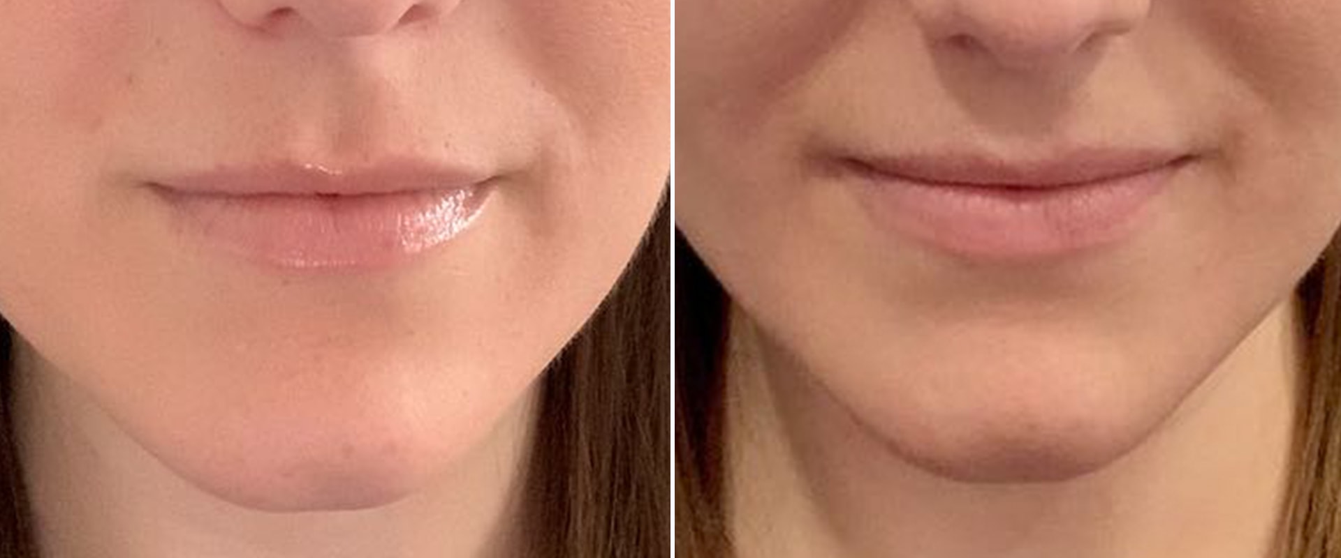 Cheek Filler: How Long Does It Take to Soften and Settle?