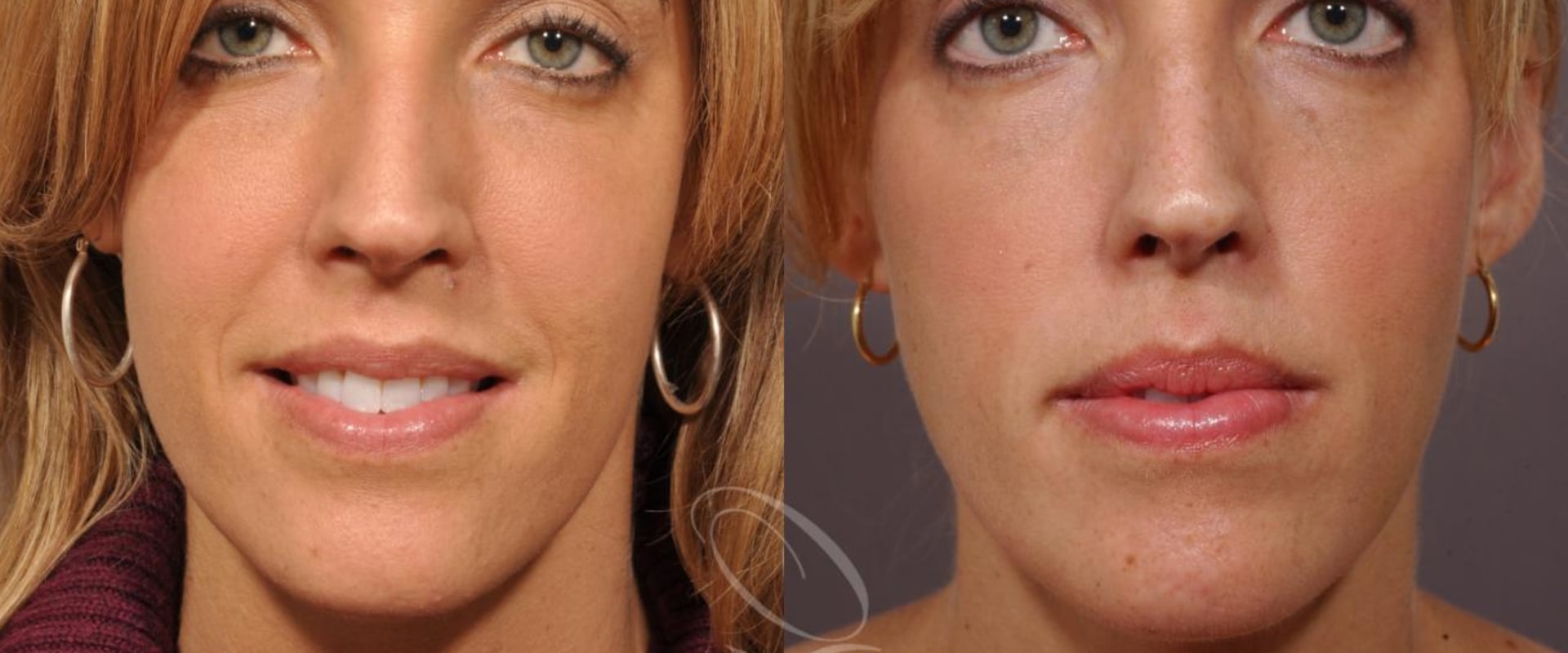 Do Cheek Implants Change Eye Shape?