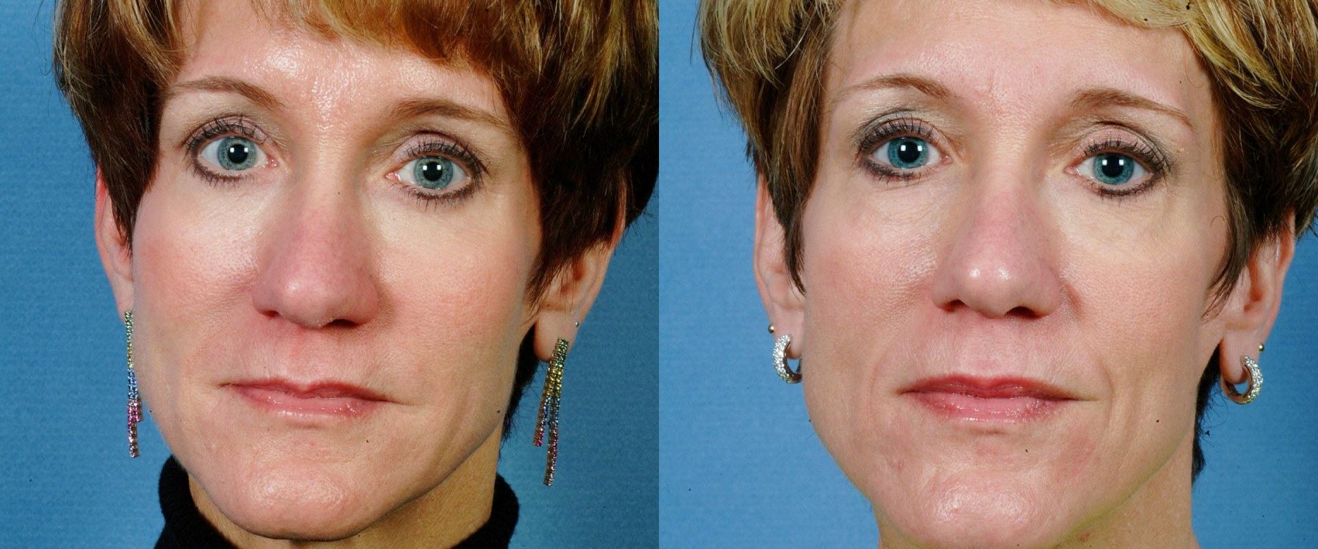 What is Face Augmentation? A Comprehensive Guide