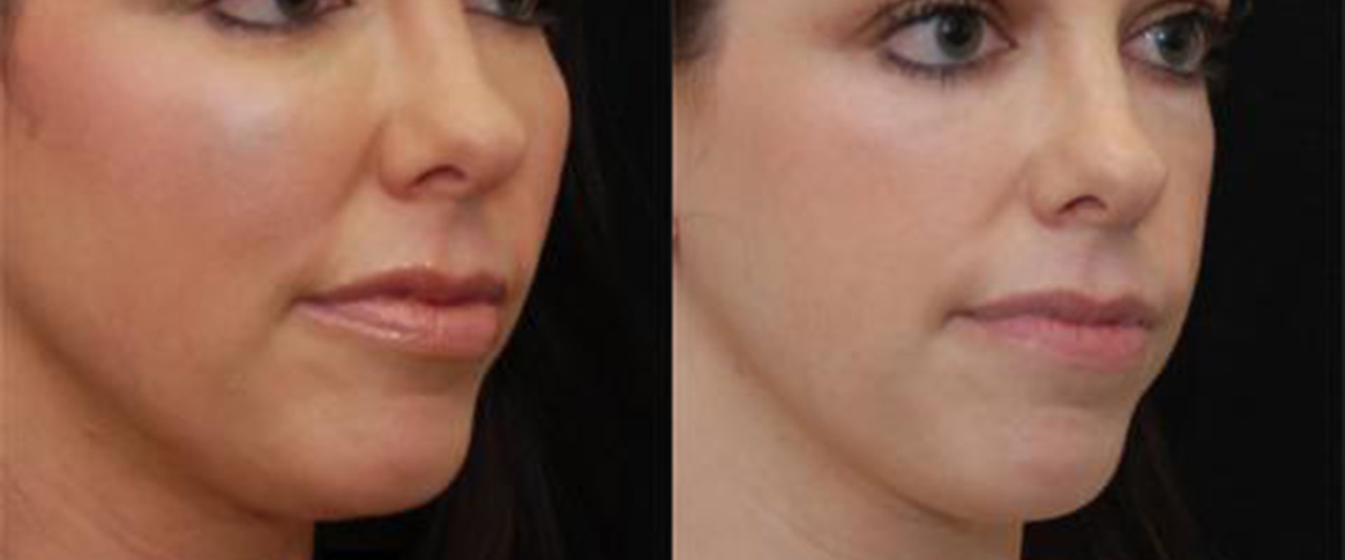 Cheek Augmentation Fat Transfer: A Natural Way to Rejuvenate Your Face