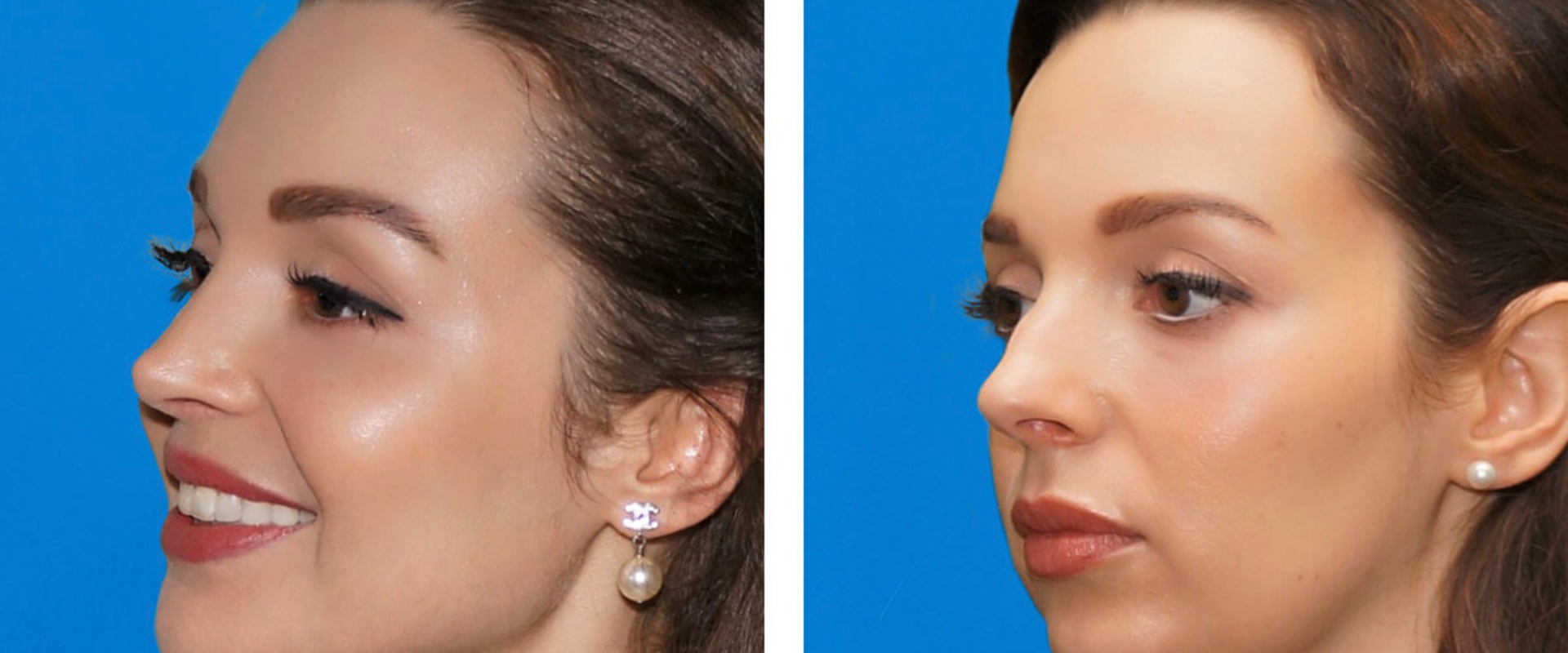 Can Cheek Implants Look Natural and Enhance Your Beauty?