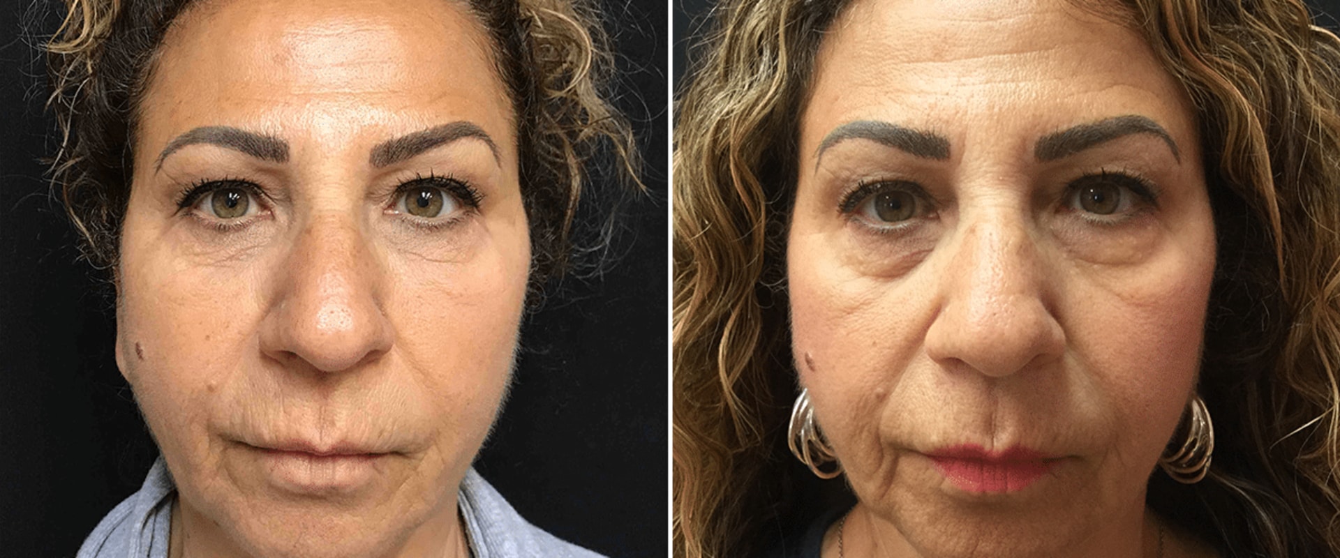 Can Filler in Cheeks Lift Jowls?