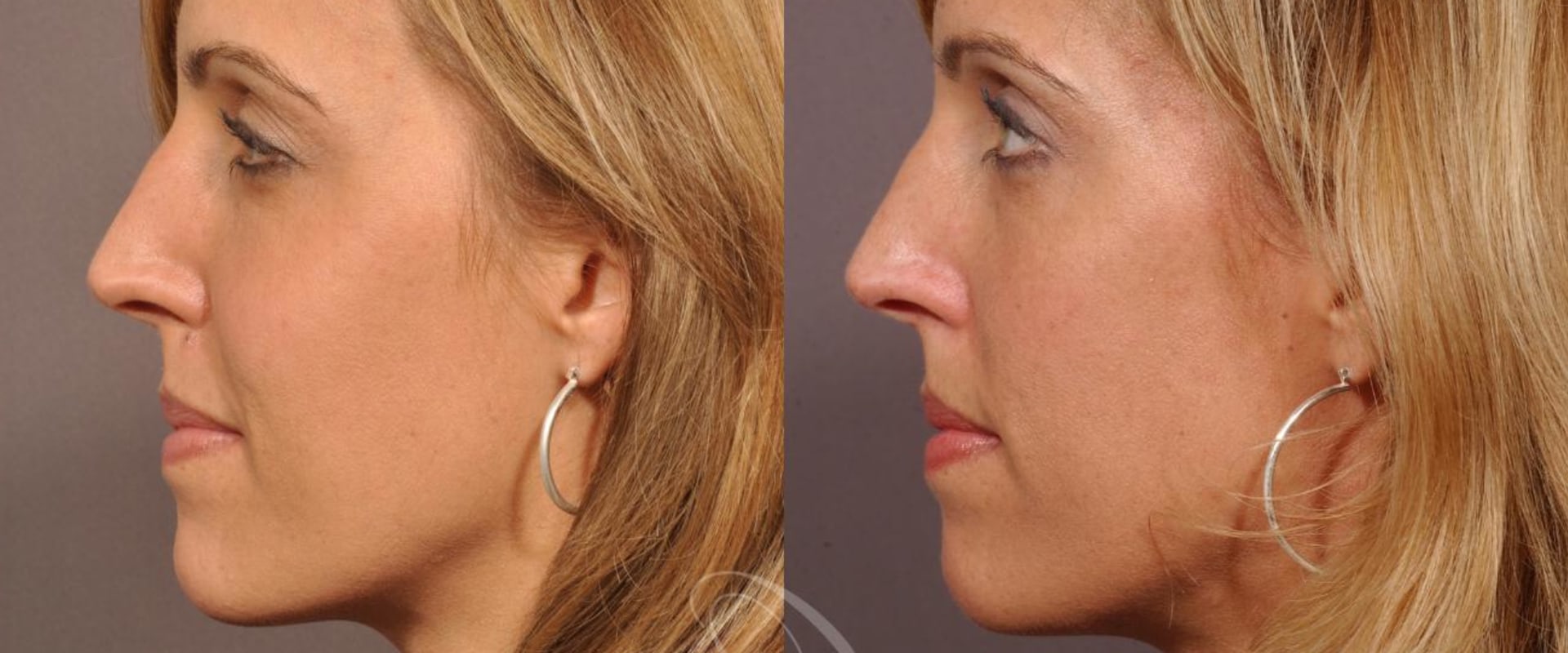 Cheek Augmentation: Before and After Results