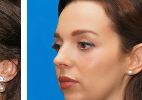 Cheek Augmentation: All You Need to Know About Cheek Implants