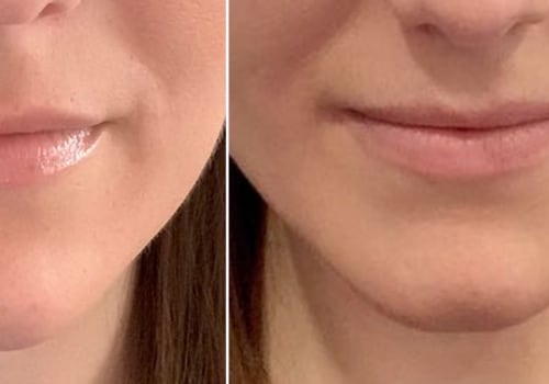 Cheek Filler: How Long Does It Take to Soften and Settle?