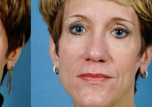 What is Face Augmentation? A Comprehensive Guide