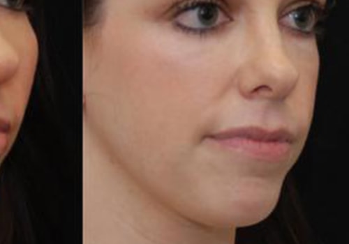 Cheek Augmentation Fat Transfer: A Natural Way to Rejuvenate Your Face