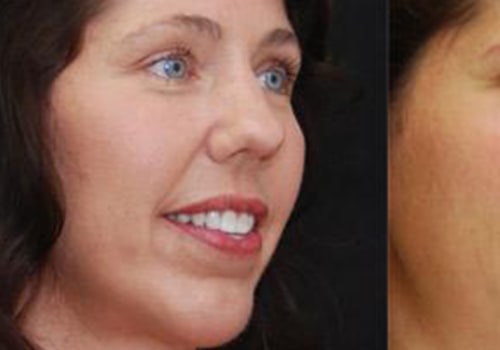 Cheek Augmentation: What Incisions Are Used?